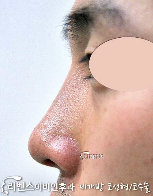 낮은 작은 눌린 코끝 매부리코 메부리코 수술 성형 교정 비중격 연골 사용 성형 s106